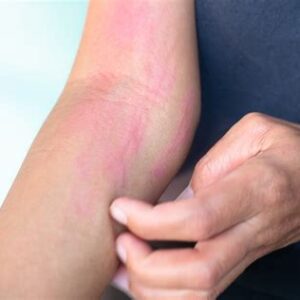 Terapia para alergias, con ingrediente: cebada