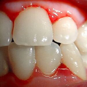 Terapia para escorbuto, con ingrediente: linaza