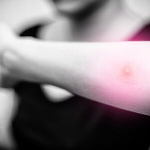 Terapia para hinchazón, con ingrediente: saúco