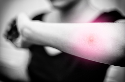 Terapia para hinchazón, con ingrediente: saúco