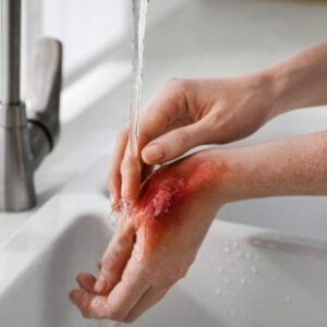 Terapia para quemaduras, con ingrediente: tomate