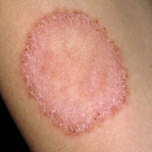 Terapia para tiña, con ingrediente: palojiote