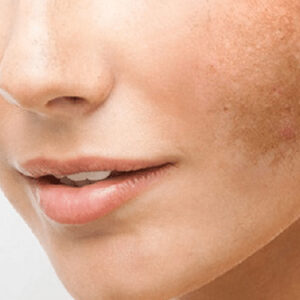 Terapia para paño en la cara, con ingrediente: arroz